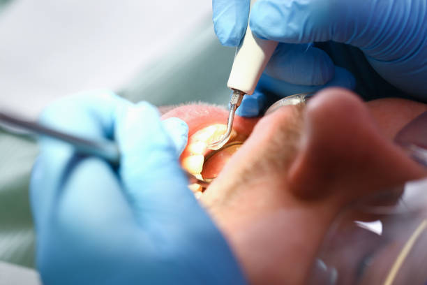Best Urgent Care for Lost Fillings or Crowns in Seeley, CA